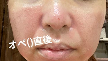 あゆみ イエベ秋2nd春 on LIPS 「イエベ秋、あゆみです。久しぶりの投稿はセルフダーマペンについて..」（3枚目）