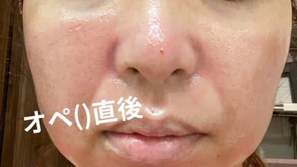 あゆみ イエベ秋2nd春 on LIPS 「イエベ秋、あゆみです。久しぶりの投稿はセルフダーマペンについて..」(3枚目)