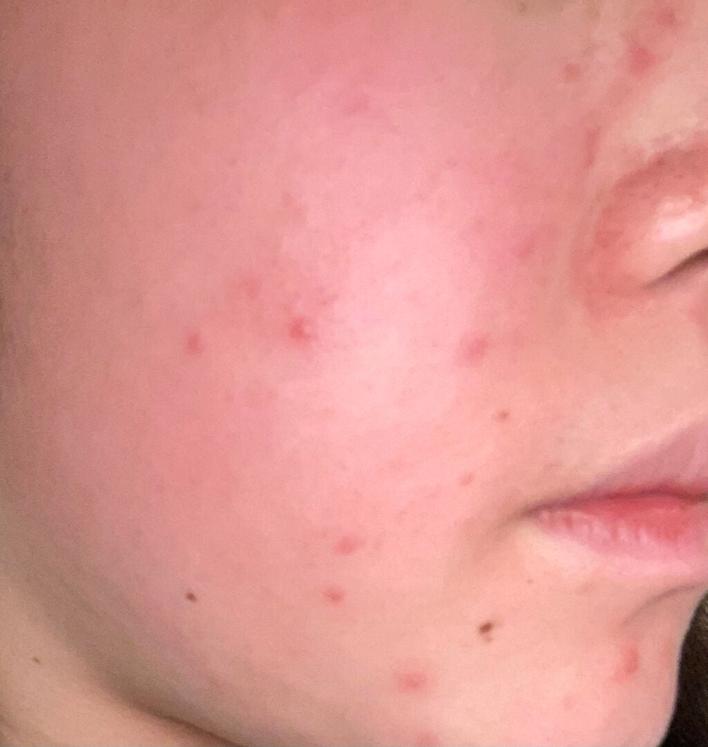 にににん on LIPS 「べピオ使用5日目です記録として残させていただきます三日目同様、..」(2枚目)