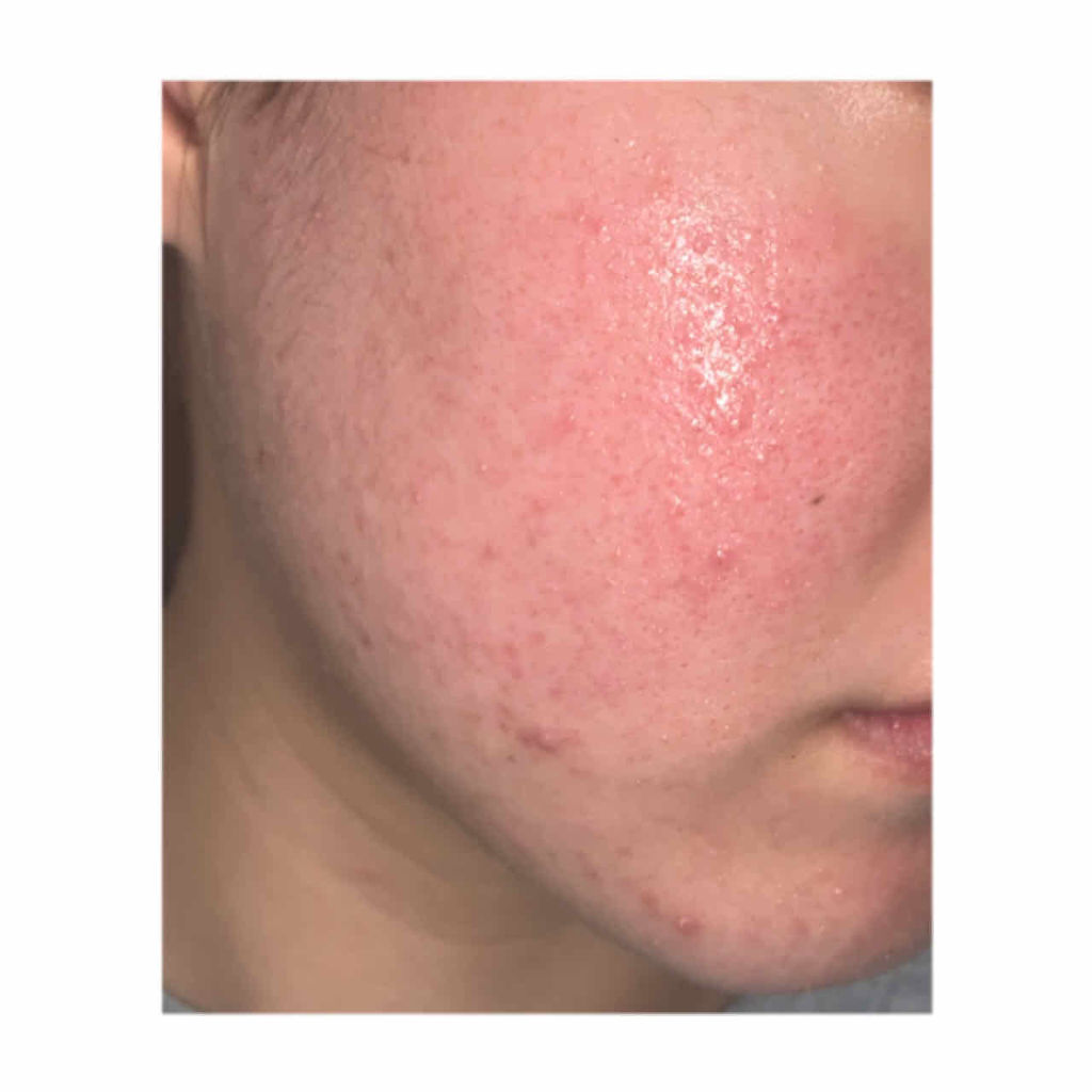 マシュマロホイップ 薬用アクネケア/ビオレ/泡洗顔を使ったクチコミ（3枚目）