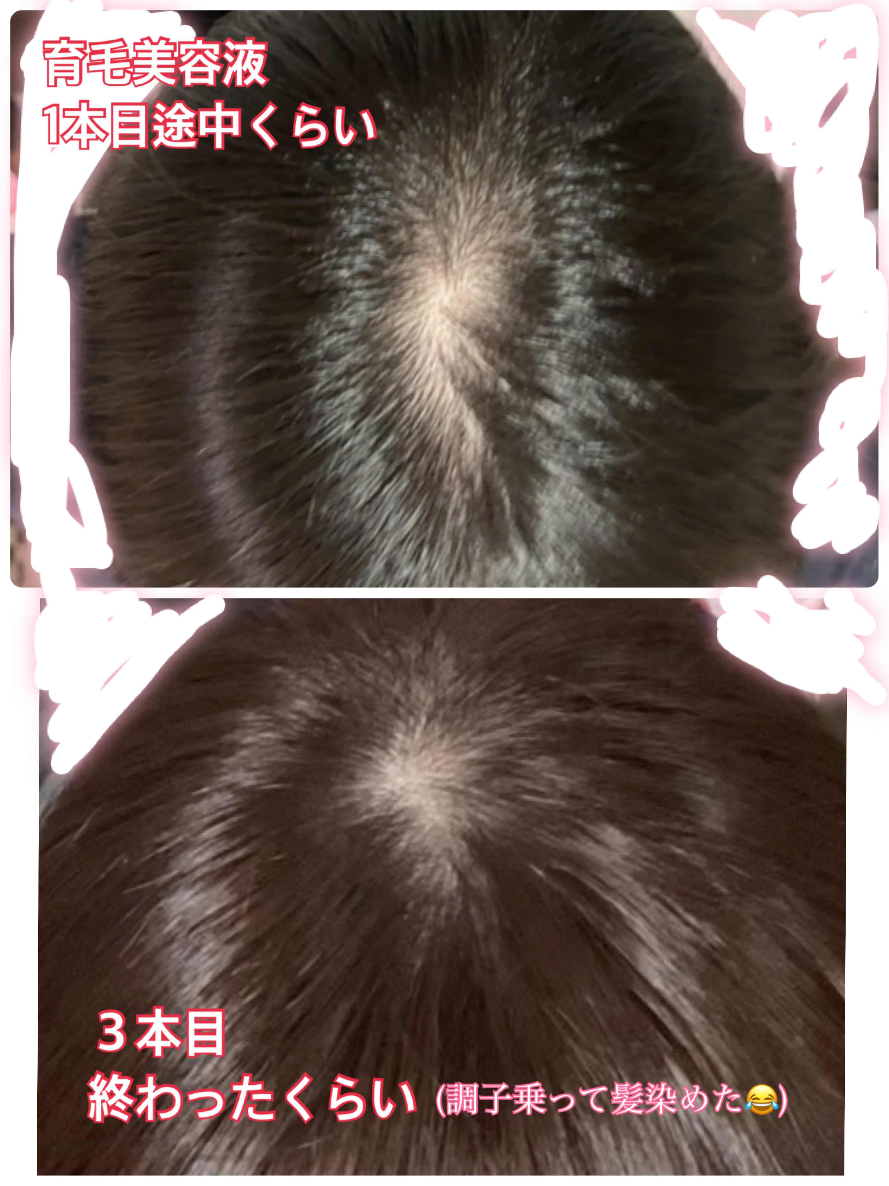 薬用 メディカル アンチヘアロスセラム/L'OCCITANE/頭皮ローションを使ったクチコミ（2枚目）