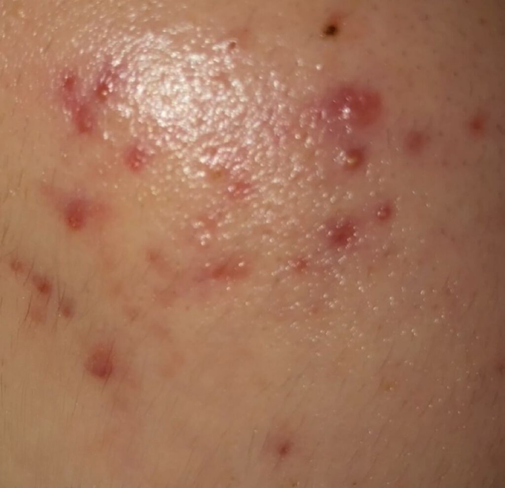 クラリファイング ローション 2/CLINIQUE/拭き取り化粧水を使ったクチコミ（1枚目）