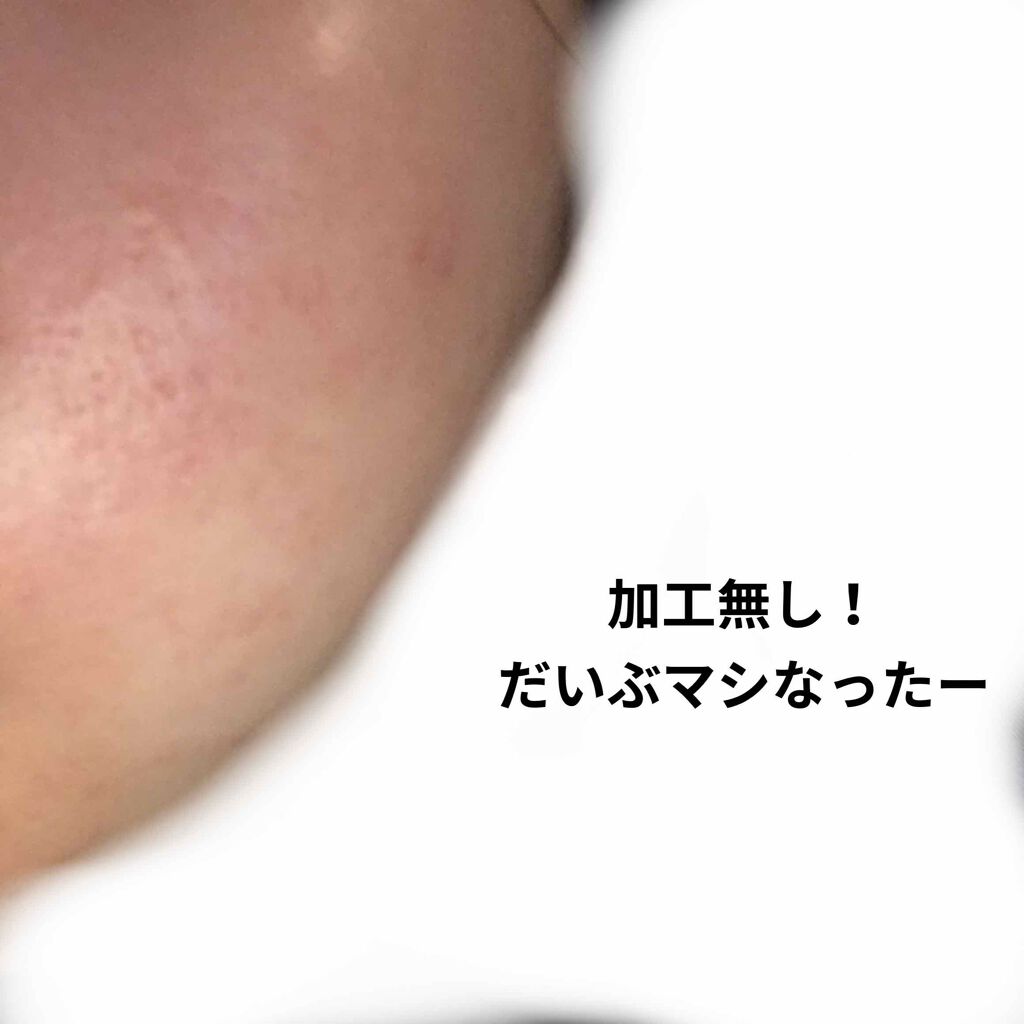 エピデュオゲル/マルホ株式会社/その他を使ったクチコミ（3枚目）