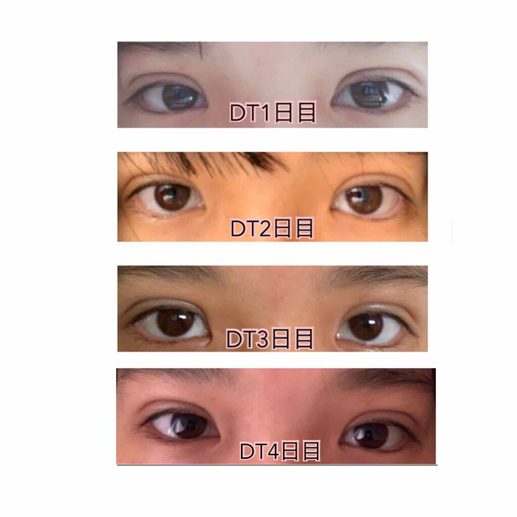 二重整形/その他を使ったクチコミ（2枚目）