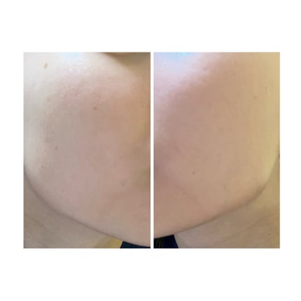 ぽむ on LIPS 「2023.9.13皮膚科に受診 エピデュオとヘパリン処方1枚目..」(4枚目)