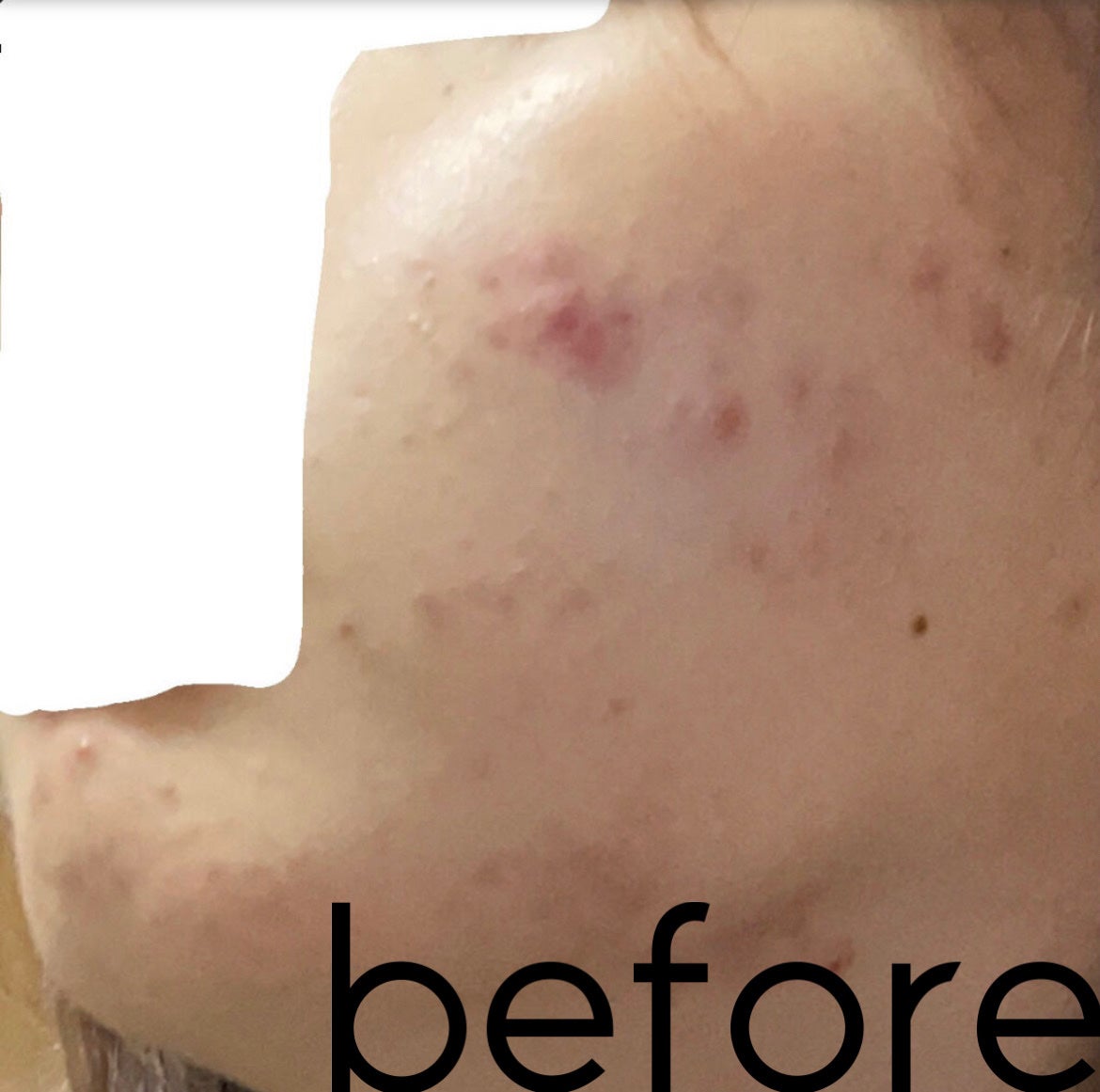 ひな on LIPS 「自己流でいくつか試して見たけどやっぱり皮膚科に行くのがいちばん..」(4枚目)