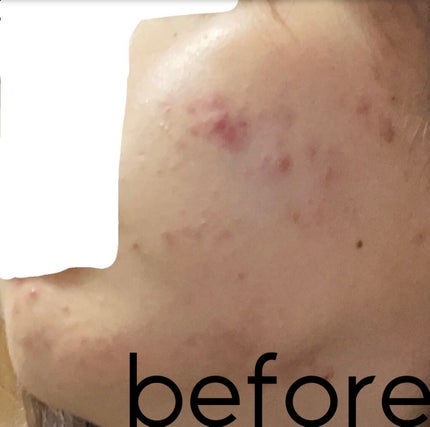 ひな on LIPS 「自己流でいくつか試して見たけどやっぱり皮膚科に行くのがいちばん..」(4枚目)