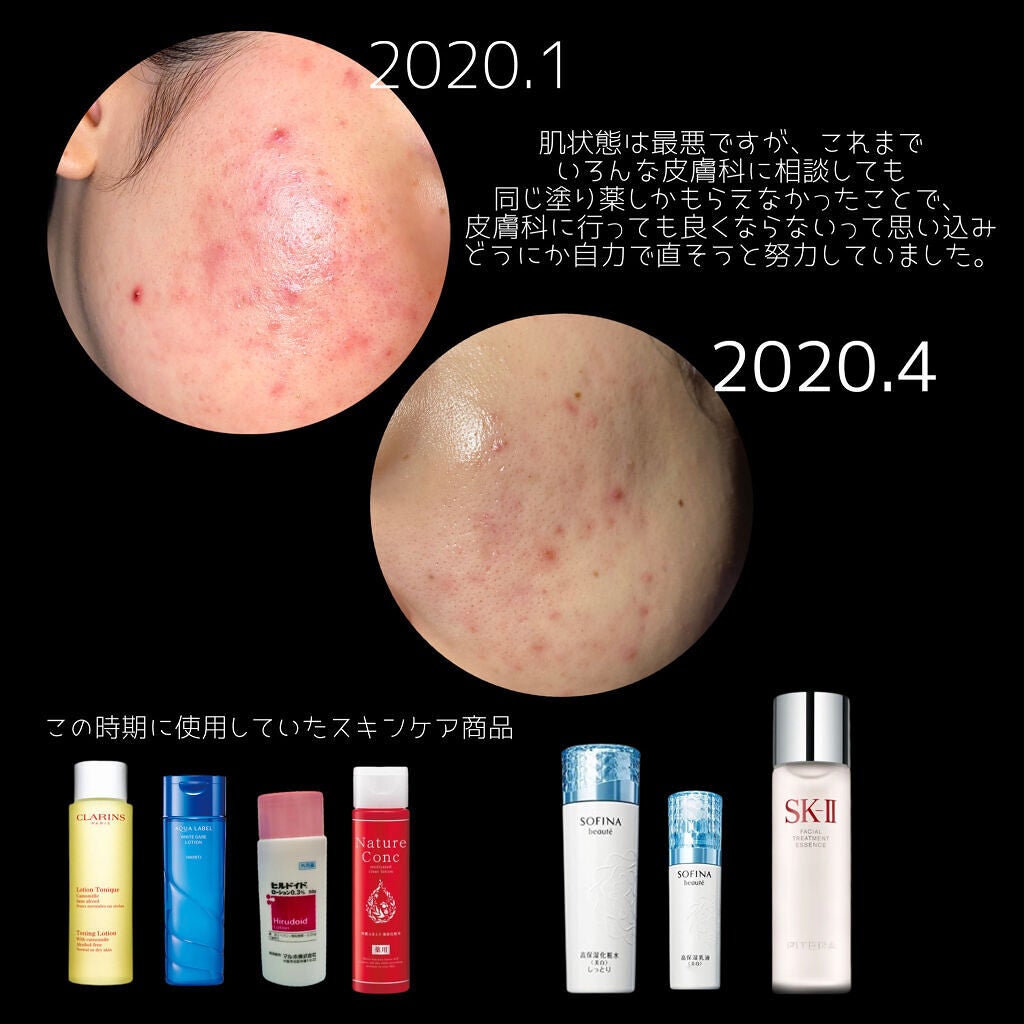 モイストバランス ローション/ACSEINE/化粧水を使ったクチコミ(3枚目)