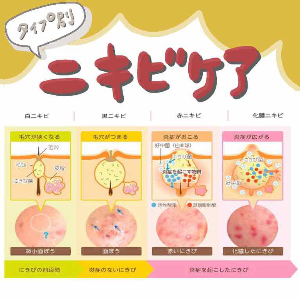 アクネローション/メンターム/化粧水を使ったクチコミ(1枚目)