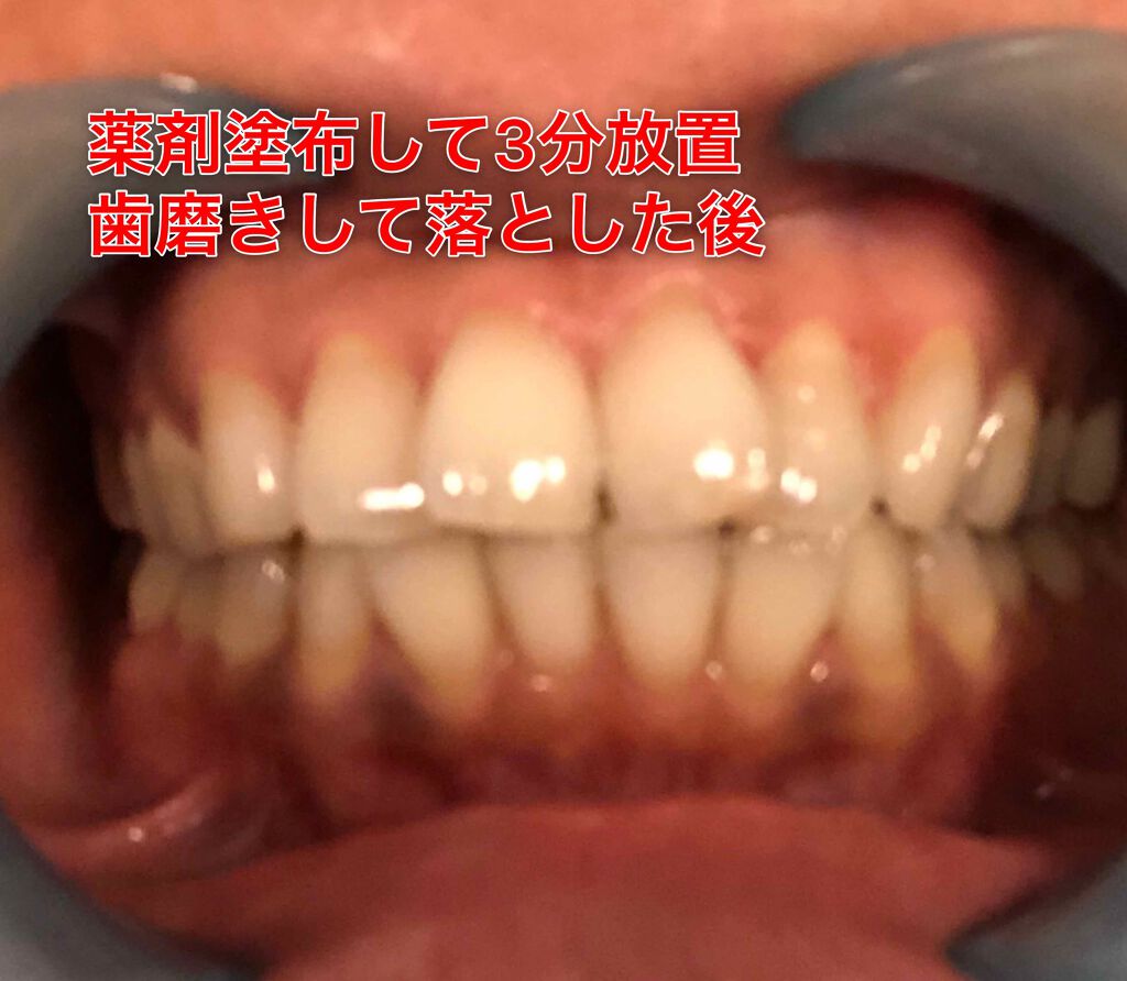 ホワイトニングペン/ボディマジック/その他オーラルケアを使ったクチコミ(4枚目)