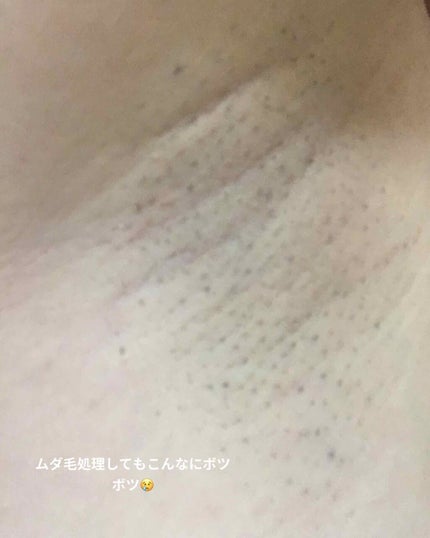 FASIZ IPL脱毛器/FASIZ/家庭用脱毛器を使ったクチコミ(2枚目)