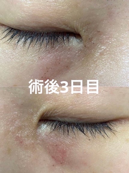 みっすん on LIPS 「目の下のポツポツをアグネスで治療してみた───────────..」(5枚目)