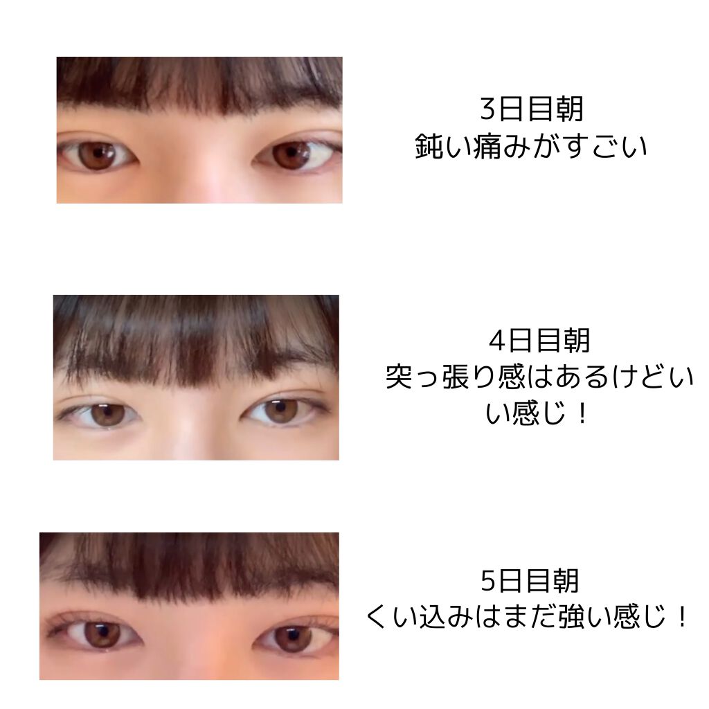 R@フォロバ100 on LIPS 「お久しぶりです!この度二重整形をして参りました!レポをしたいと..」(3枚目)