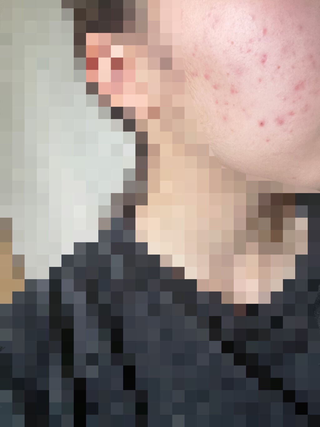 ニキビ治療薬(医薬品)/メンソレータム アクネス/その他を使ったクチコミ(2枚目)