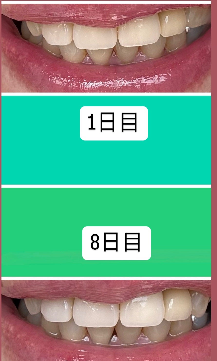 アパガードセレナ/アパガード/歯磨き粉を使ったクチコミ(4枚目)