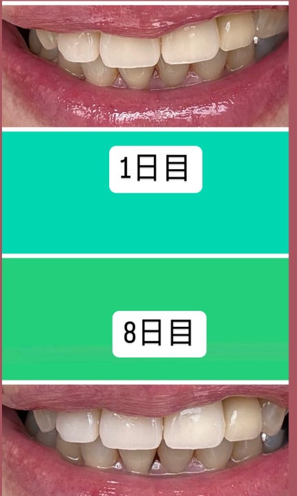 アパガードセレナ/アパガード/歯磨き粉を使ったクチコミ(4枚目)
