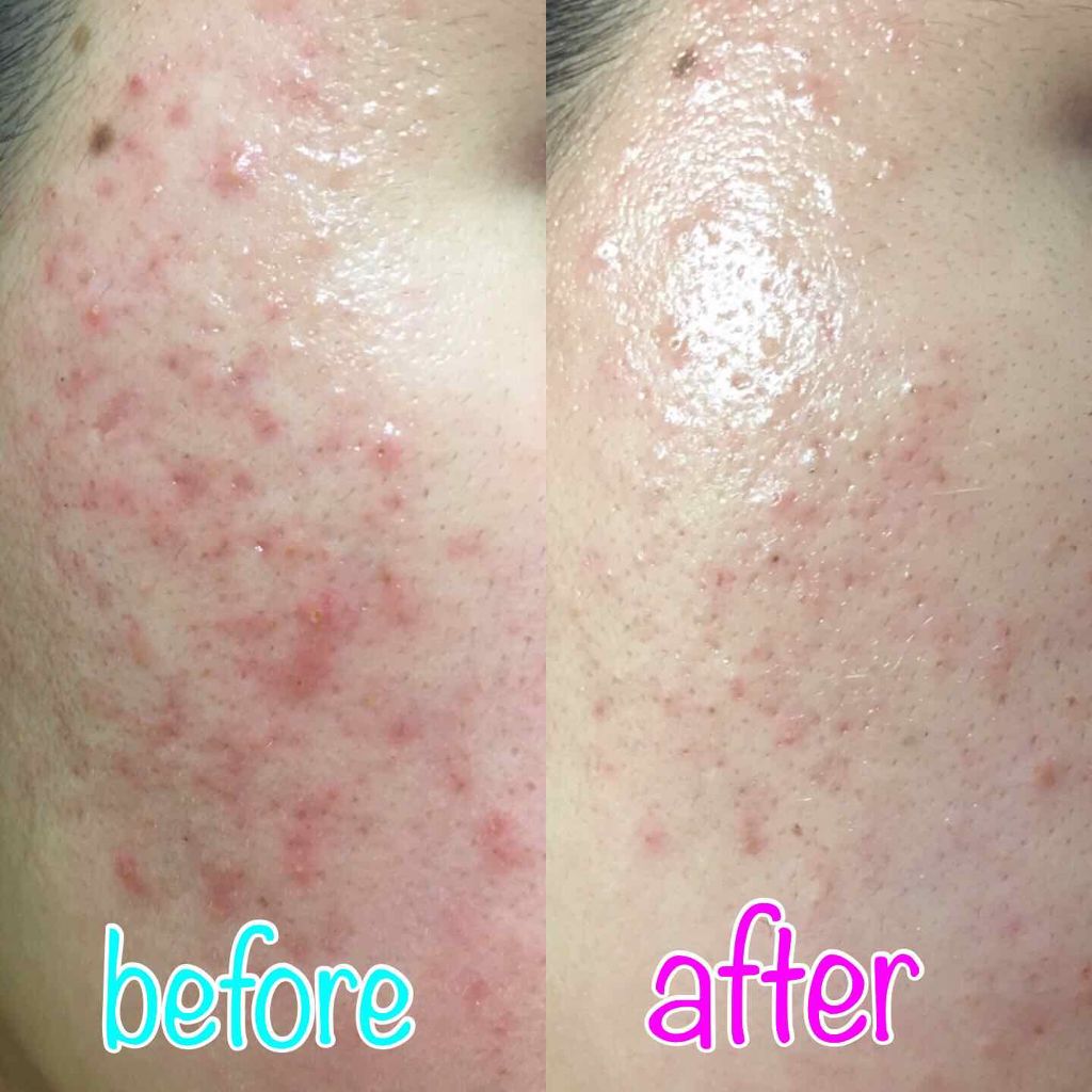 薬用しみ対策 美白化粧水/メラノCC/化粧水を使ったクチコミ（2枚目）