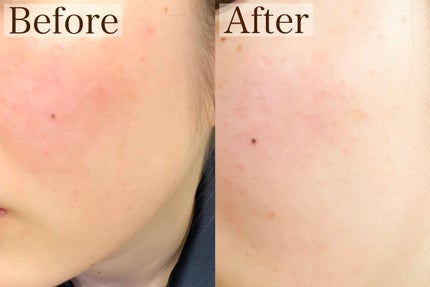 リードルショット300/VT/美容液を使ったクチコミ(3枚目)