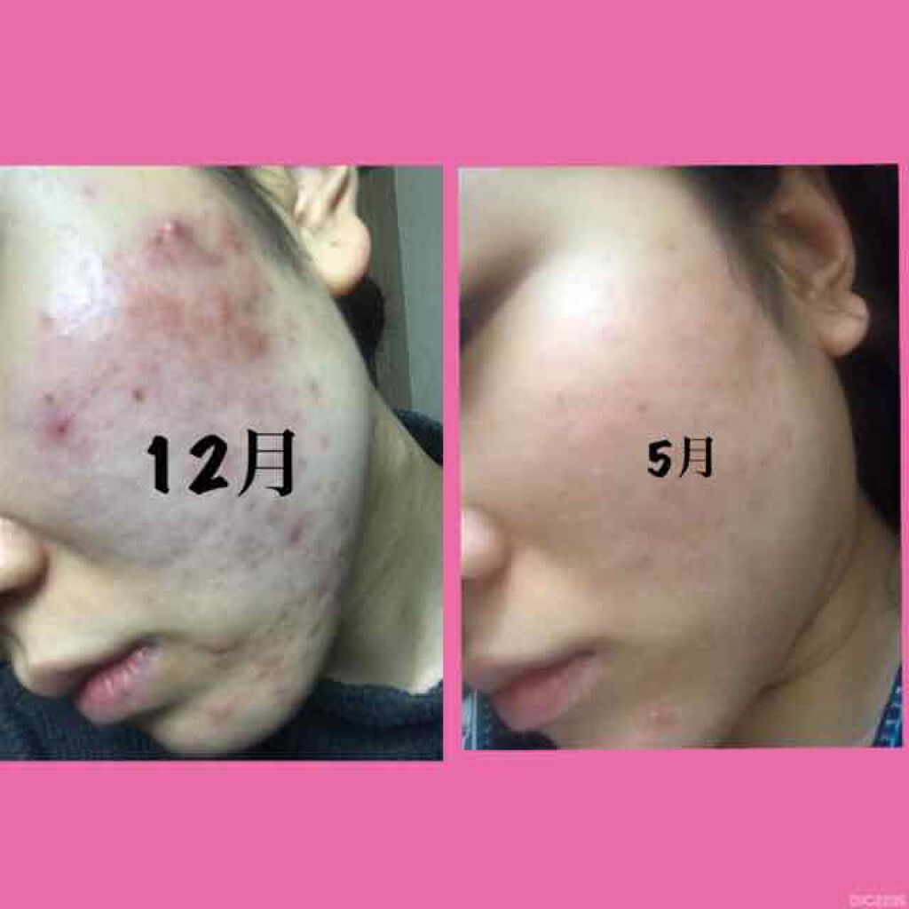 おかめ on LIPS 「【スキンケア】まだ跡がたくさん残ってるし半年かかったけど、ここ..」(1枚目)