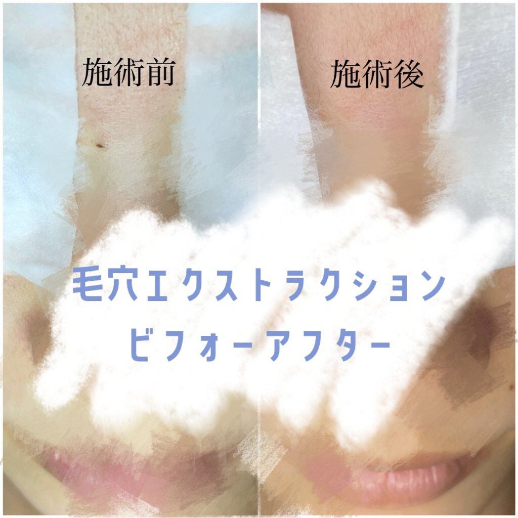 Haruka on LIPS 「毛穴エクストラクションを受けてきたビフォーアフターとレポを投稿..」(1枚目)