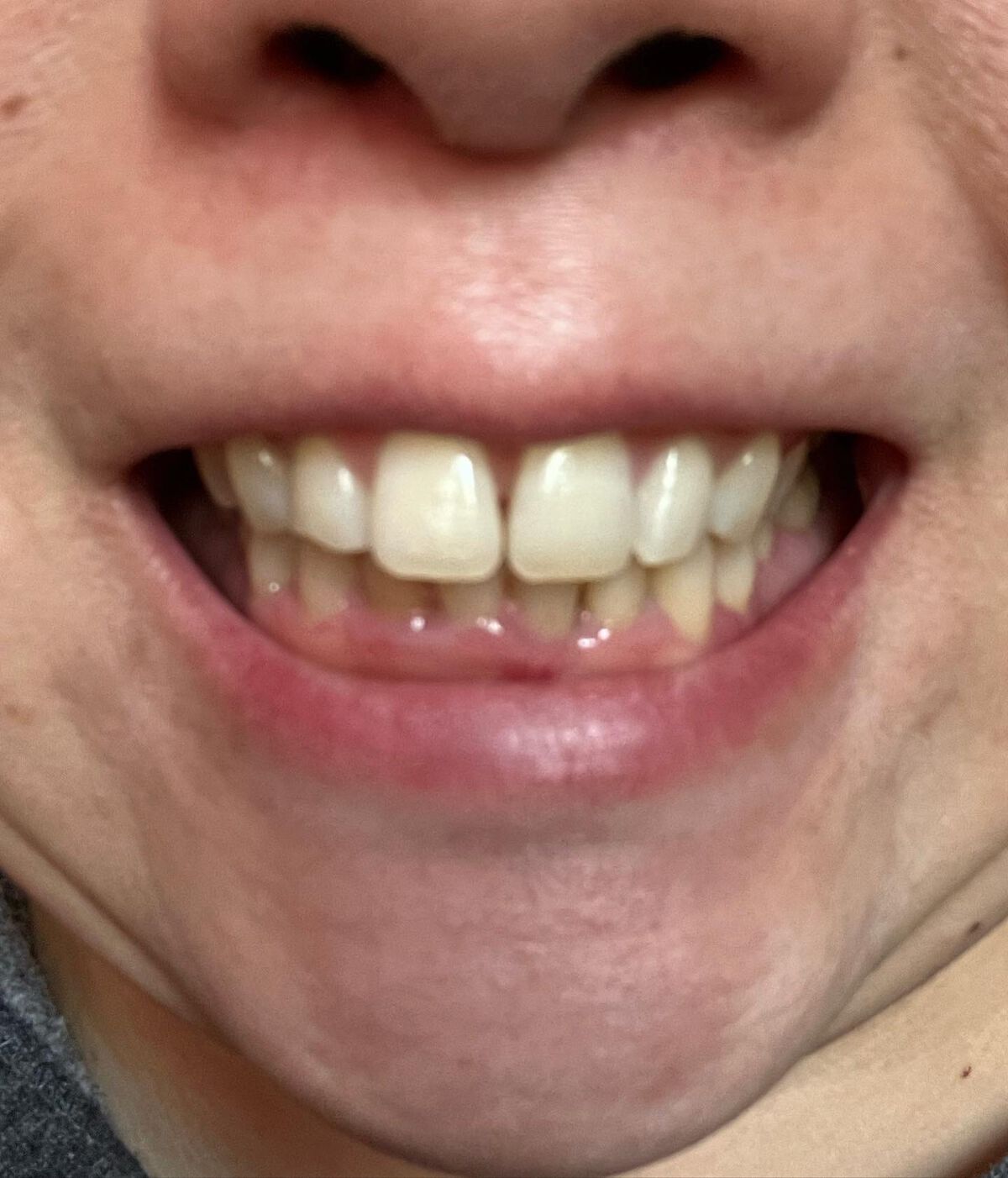 DENTA ONE/シーヴァ/その他を使ったクチコミ(6枚目)