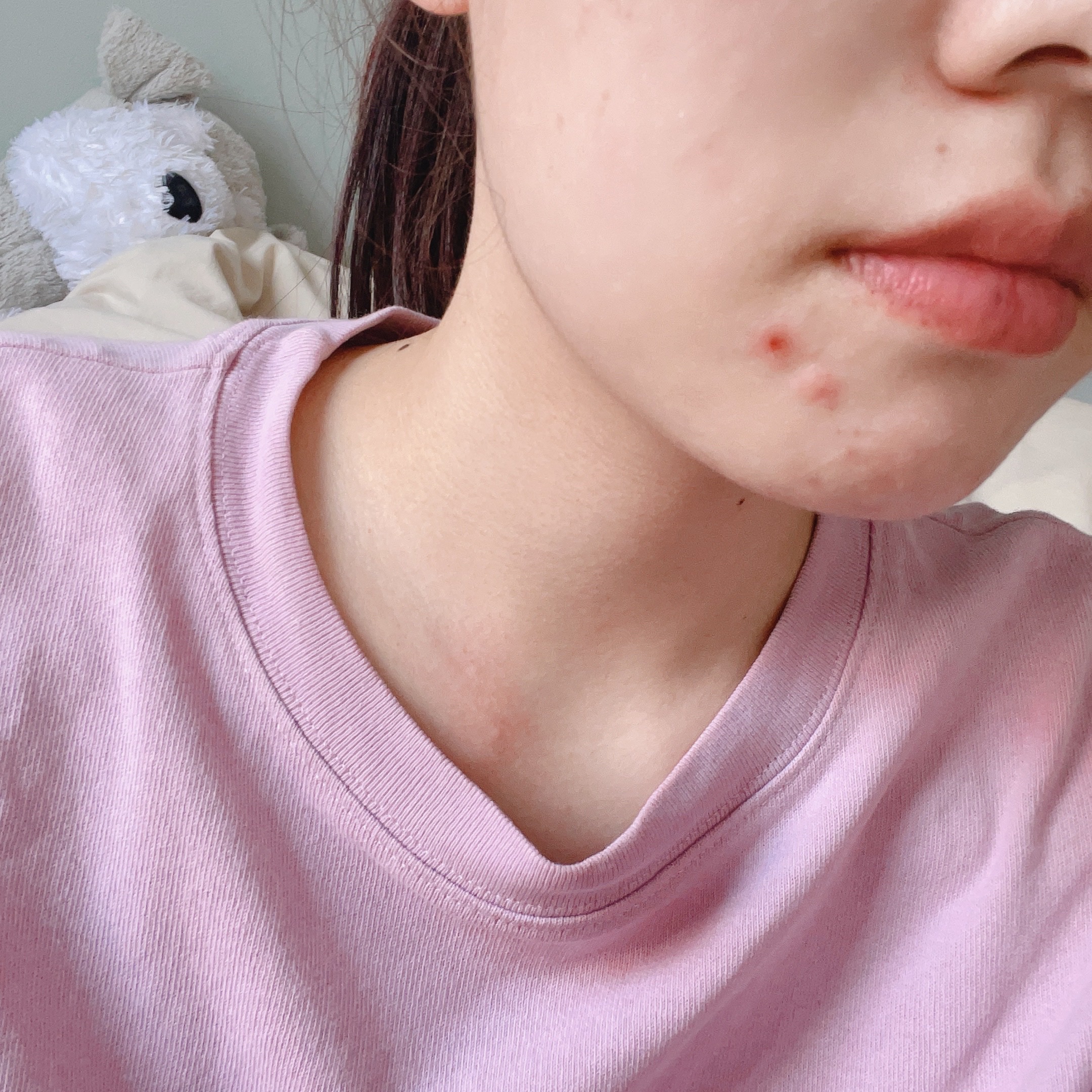 ペアアクネクリームW(医薬品)/ペア/その他を使ったクチコミ（2枚目）