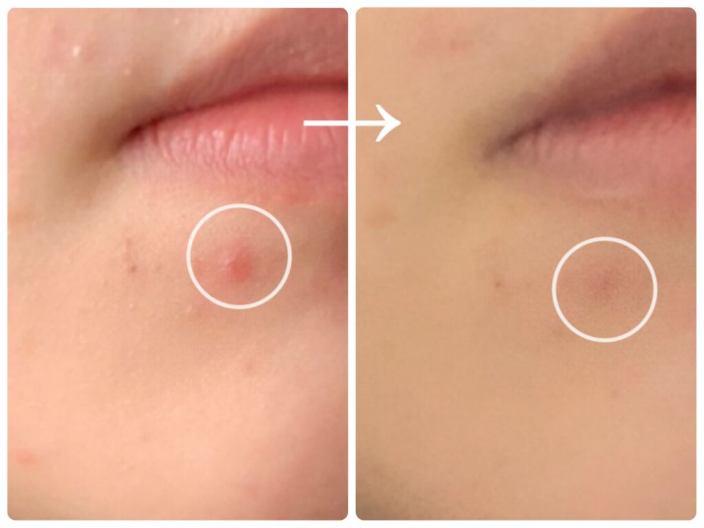 ゼロスポットパッチ/Today’s Cosme/にきびパッチを使ったクチコミ（2枚目）