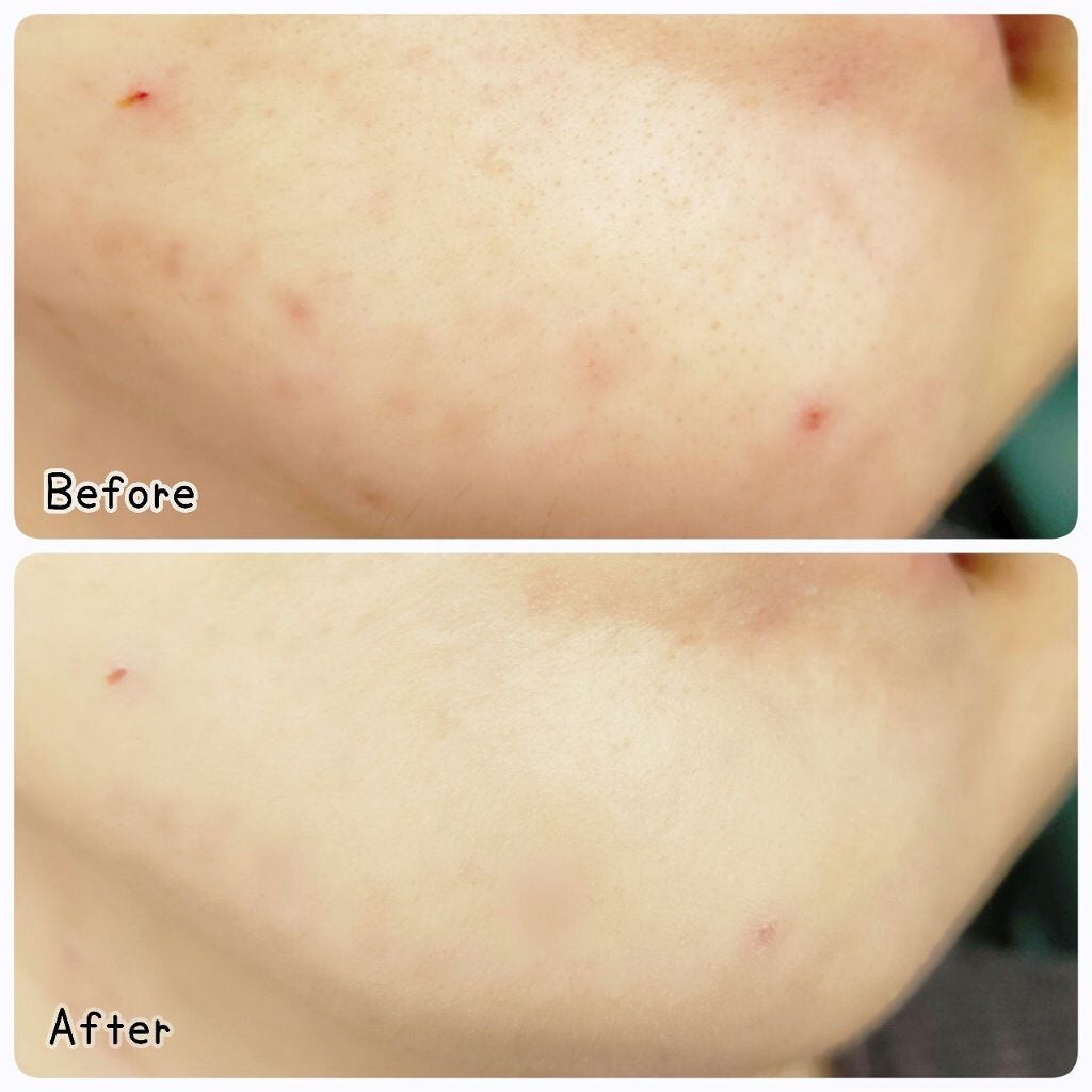 スーパーシカクイックマスクパック/MEDICUBE/シートマスク・パックを使ったクチコミ(5枚目)