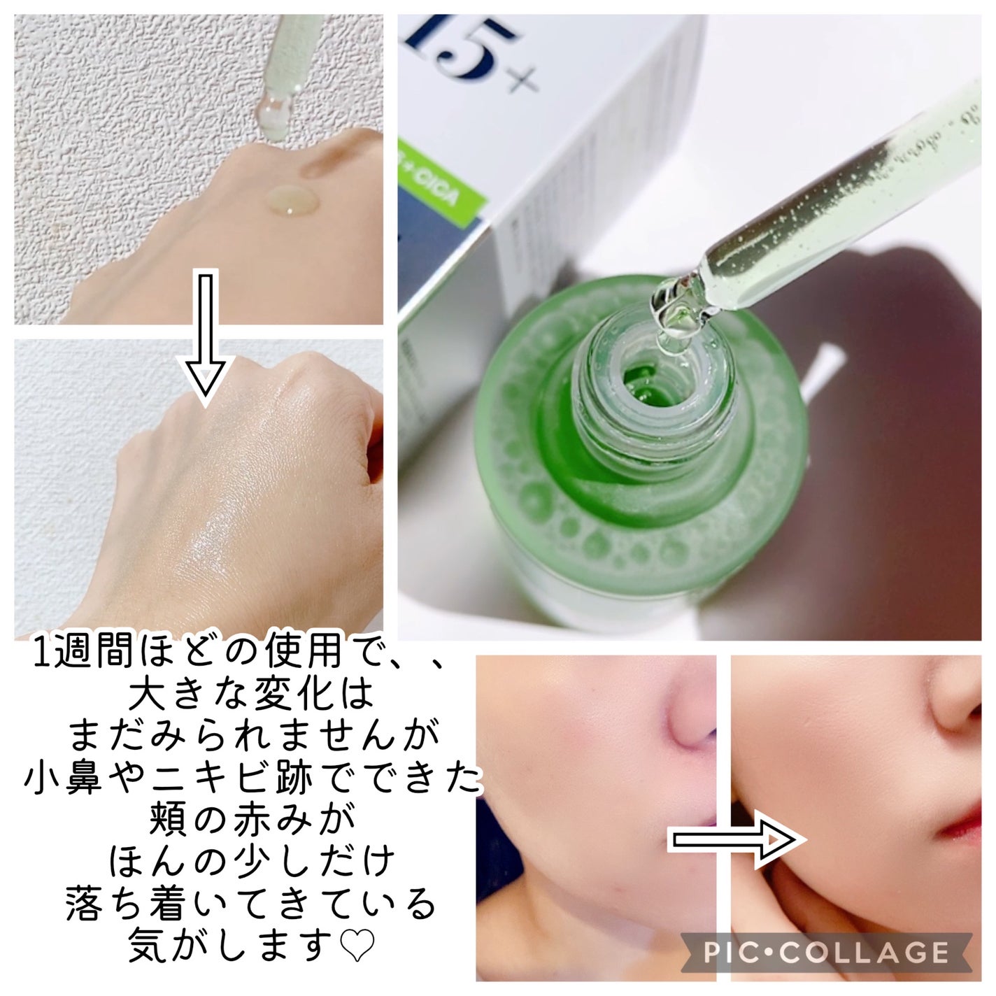 アゼライン酸15 インテンスカーミングセラム/Anua/美容液を使ったクチコミ(4枚目)