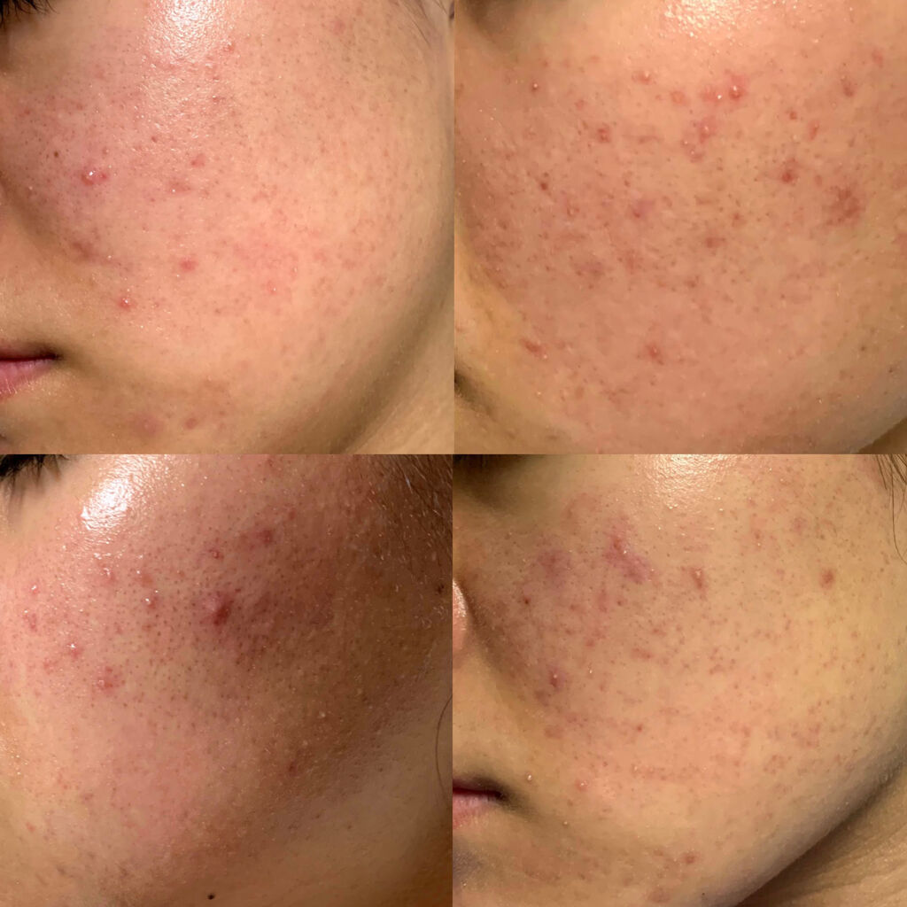 ヤーズフレックス配合錠(医薬品)/バイエル薬品/その他を使ったクチコミ（3枚目）