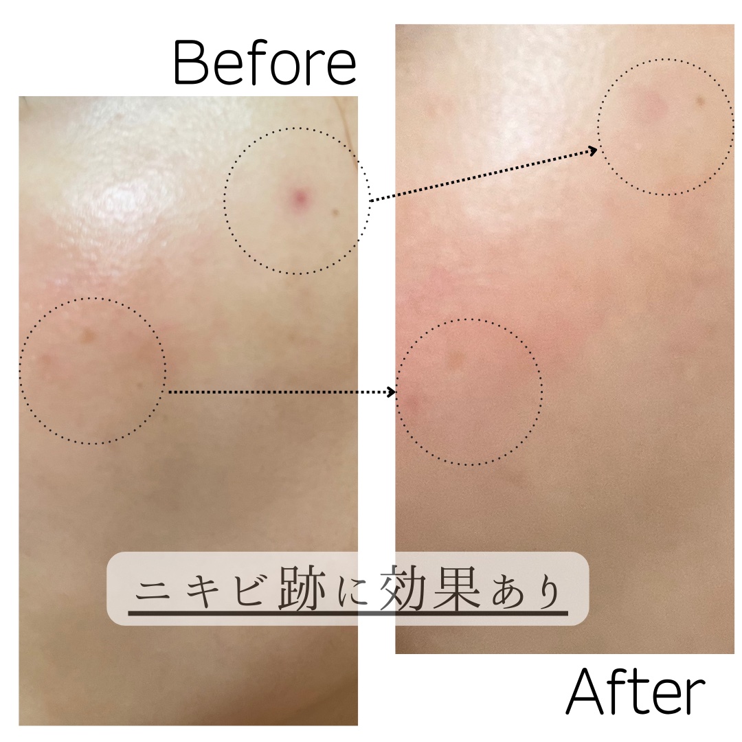 キララ❣️ 様　ホームケア　３点　ハイドロ追加 BDM-030対応】eXtremeRate ホールクリッキーキット組み立て（背面