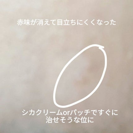 アクネピンプルマスターパッチ /COSRX/にきびパッチを使ったクチコミ(6枚目)