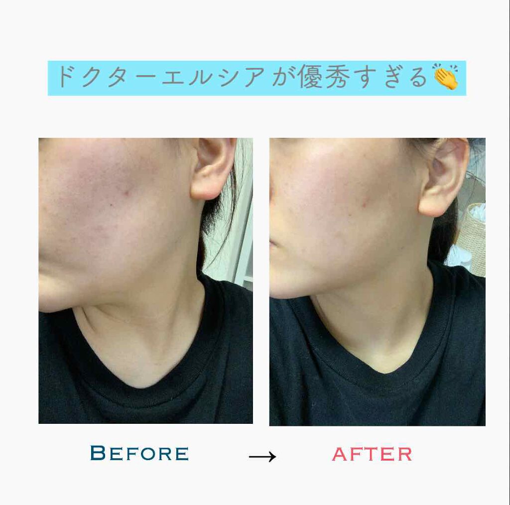 ユジ on LIPS 「前に紹介したドクターエルシア使ってみて1週間ぐらい?経ったので..」(1枚目)