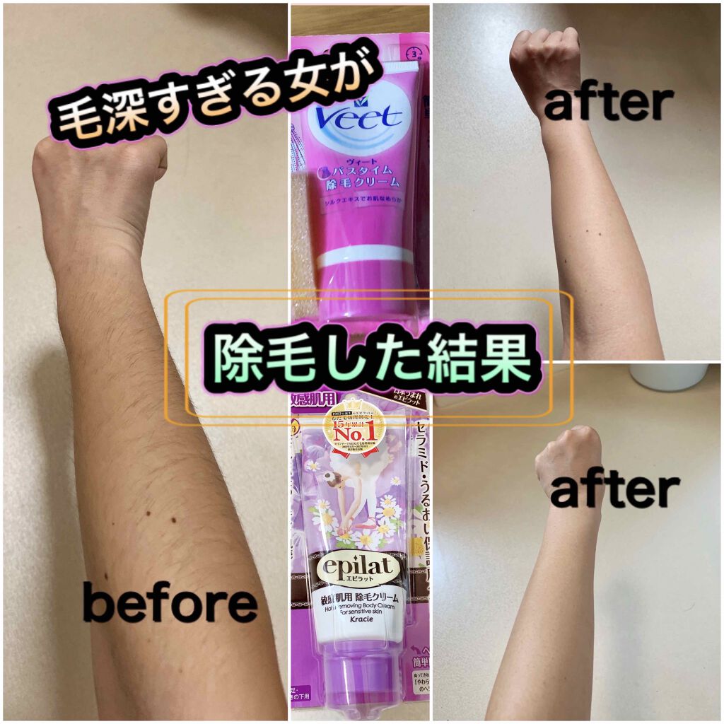 除毛クリームキット敏感肌用/エピラット/除毛クリームを使ったクチコミ(1枚目)
