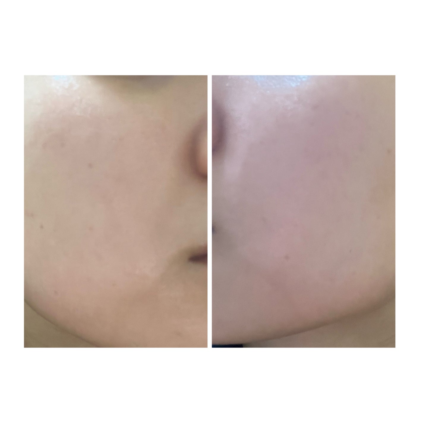 ぽむ on LIPS 「2023.9.13皮膚科に受診 エピデュオとヘパリン処方1枚目..」(1枚目)