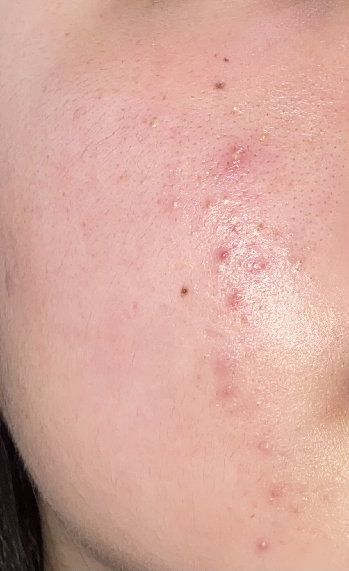 ACアクティブ トライアルセット/NOV/トライアルキットを使ったクチコミ（1枚目）