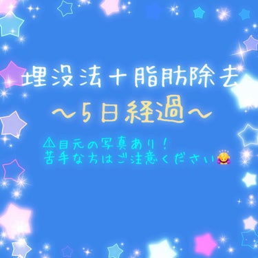 埋没法＋脂肪除去してから5日経過しました🌱
腫れは初日から比べるとだいぶ引きました。
しかしまだまだ不自然なガチャピン顔です…。

突っ張り感もだいぶ軽減されましたが、目にまつ毛やゴミが入った時のような