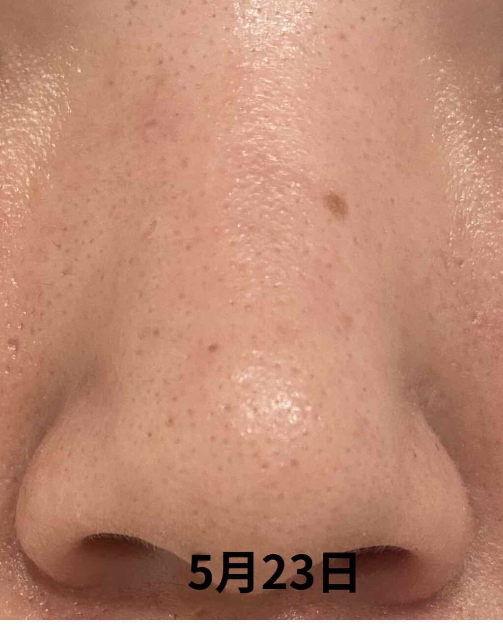 ! on LIPS 「皮膚科処方薬約2週間経過にきびはまだまだ残ってます😭でも!!鼻..」(4枚目)
