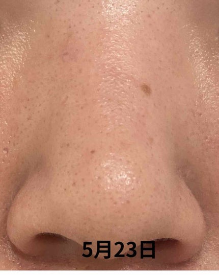! on LIPS 「皮膚科処方薬約2週間経過にきびはまだまだ残ってます😭でも!!鼻..」(4枚目)
