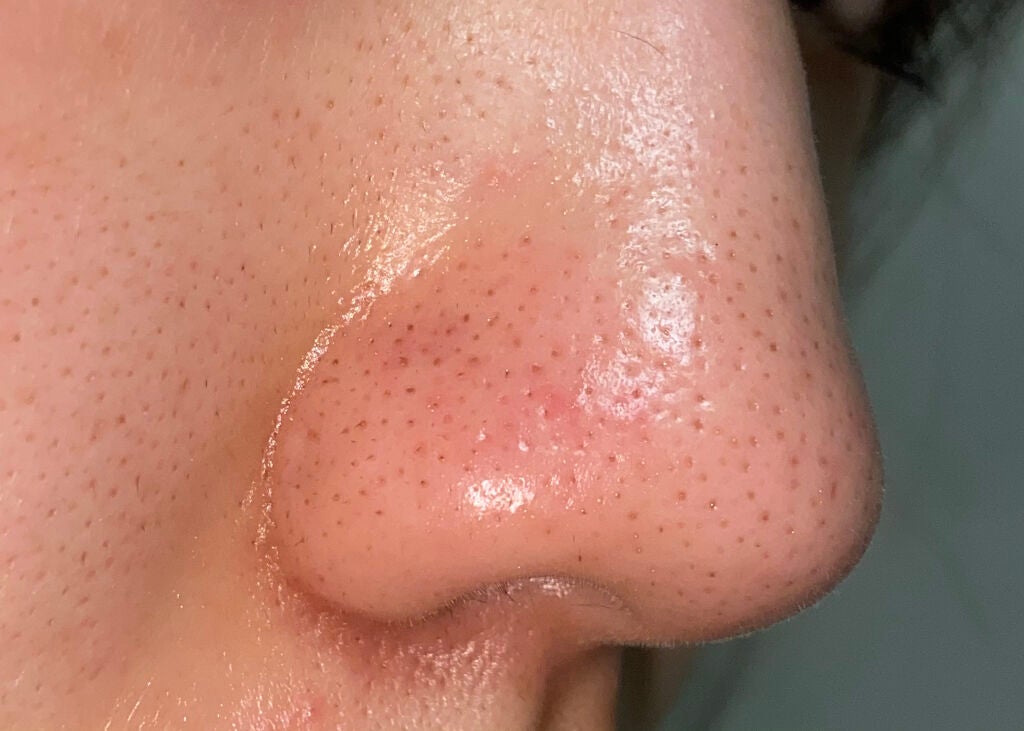 クラゲチャン on LIPS 「⚑︎銀座ミニマムスキンクリニック☾サリチル酸マクロゴールピーリ..」(2枚目)