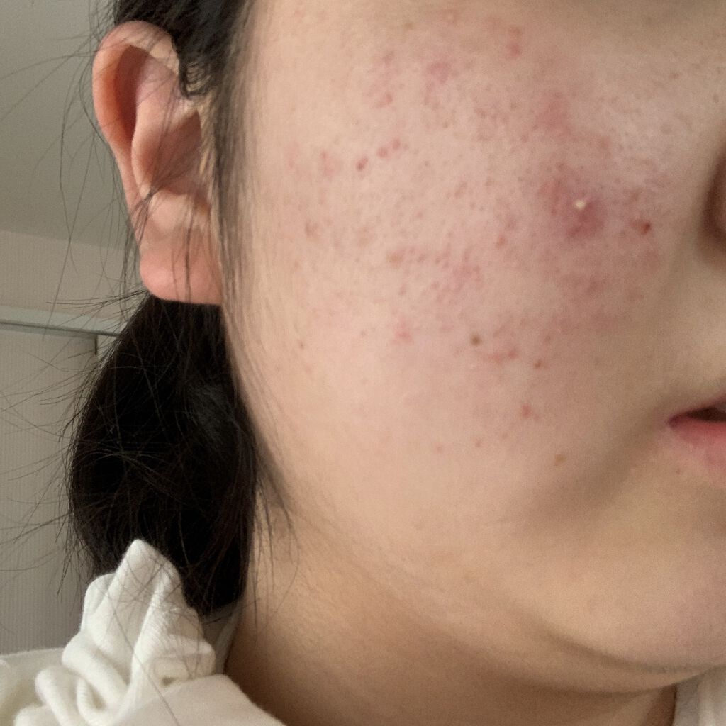 ノブ Ａ アクネソープ/NOV/洗顔石鹸を使ったクチコミ（1枚目）