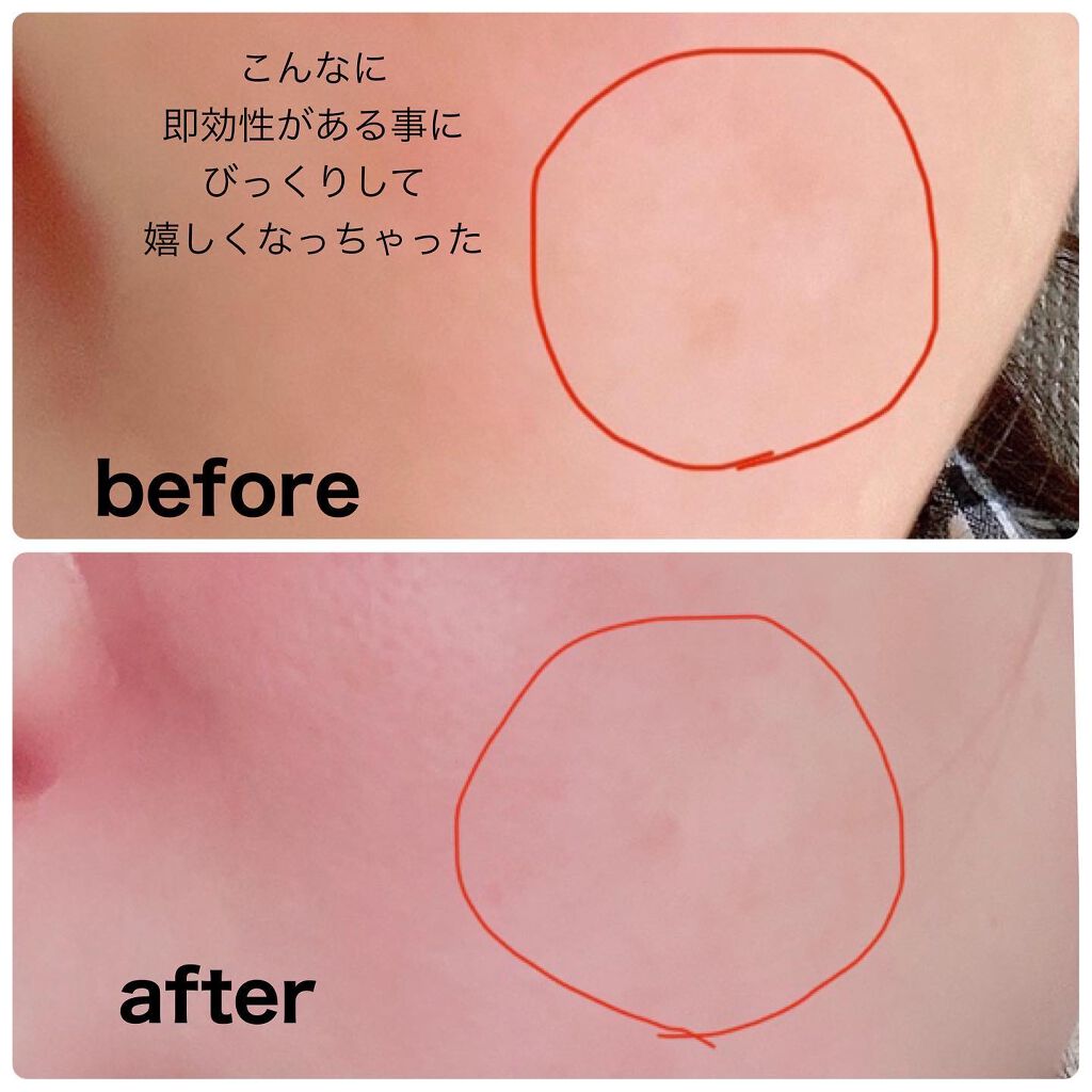 セルフダーマスタンプ5種フルセット/EYE2IN/その他スキンケアグッズを使ったクチコミ(5枚目)