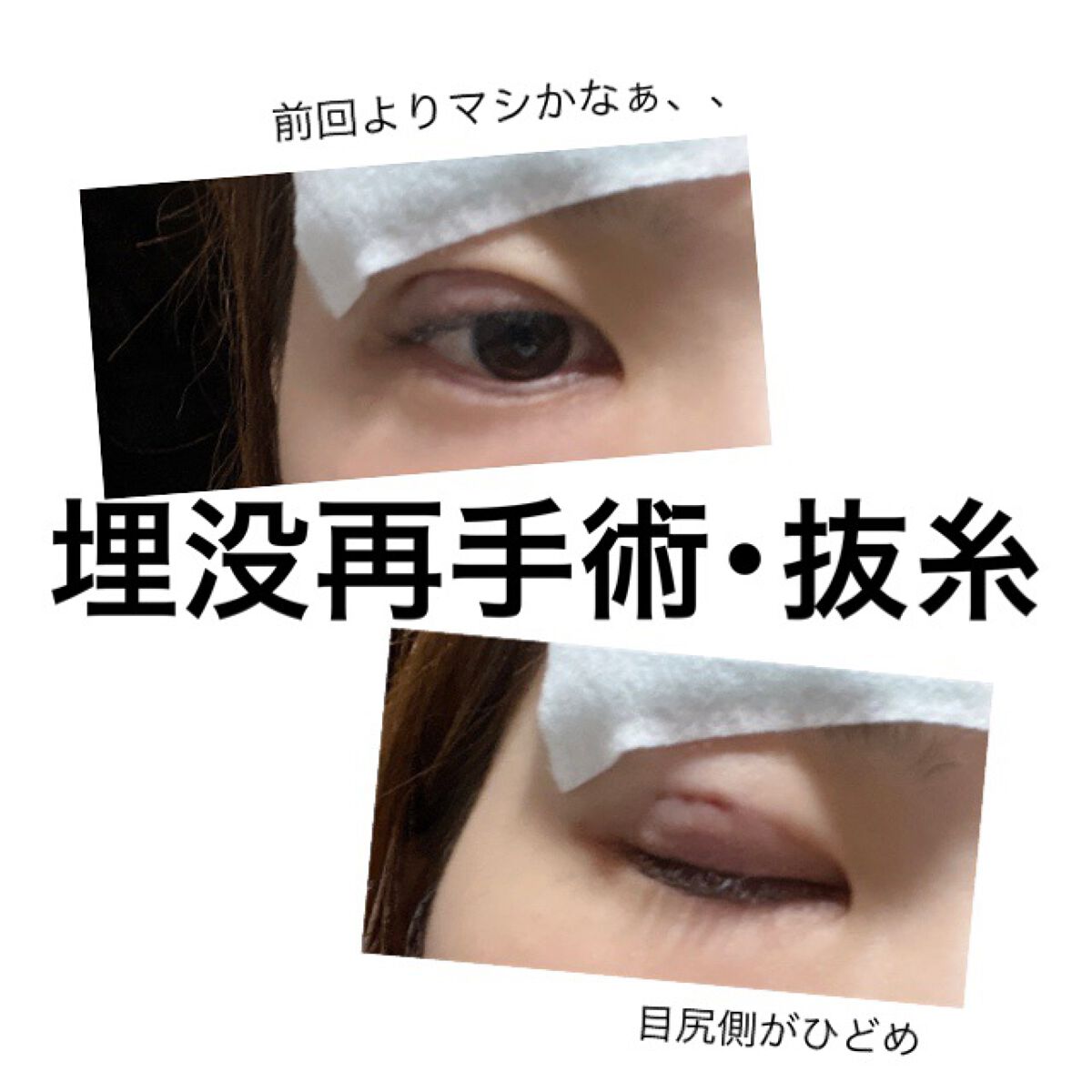 二重整形/その他を使ったクチコミ（1枚目）