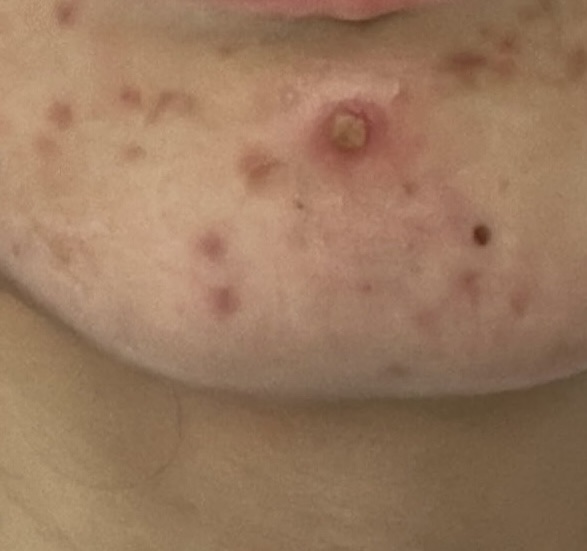 （旧）スネイルソリューションスキンブースター/ネイチャーリパブリック/ブースター・導入液を使ったクチコミ（2枚目）