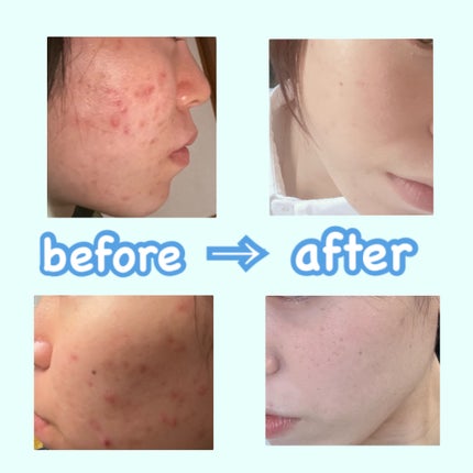 オールカーミングトナー /Easydew/化粧水を使ったクチコミ(2枚目)