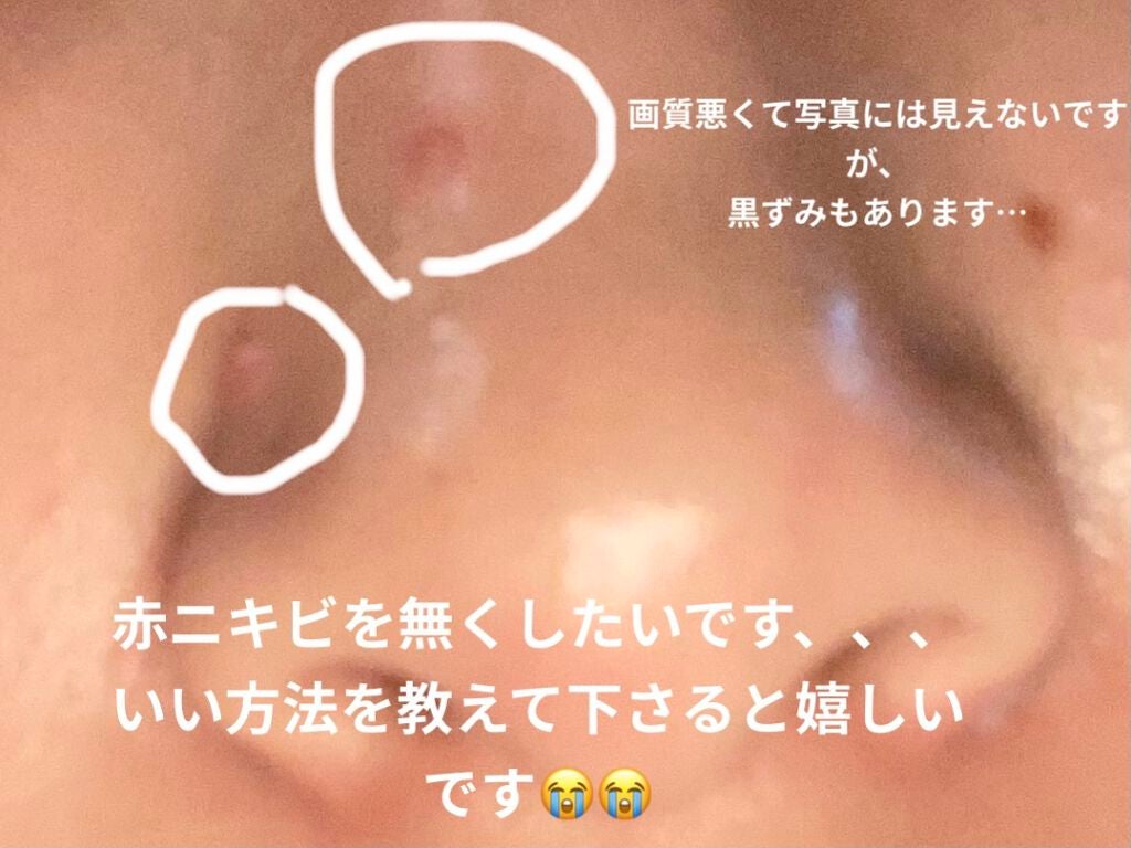 maru_ on LIPS 「赤ニキビをなくす方法を知りたいです、、色々な化粧水なども試した..」(2枚目)
