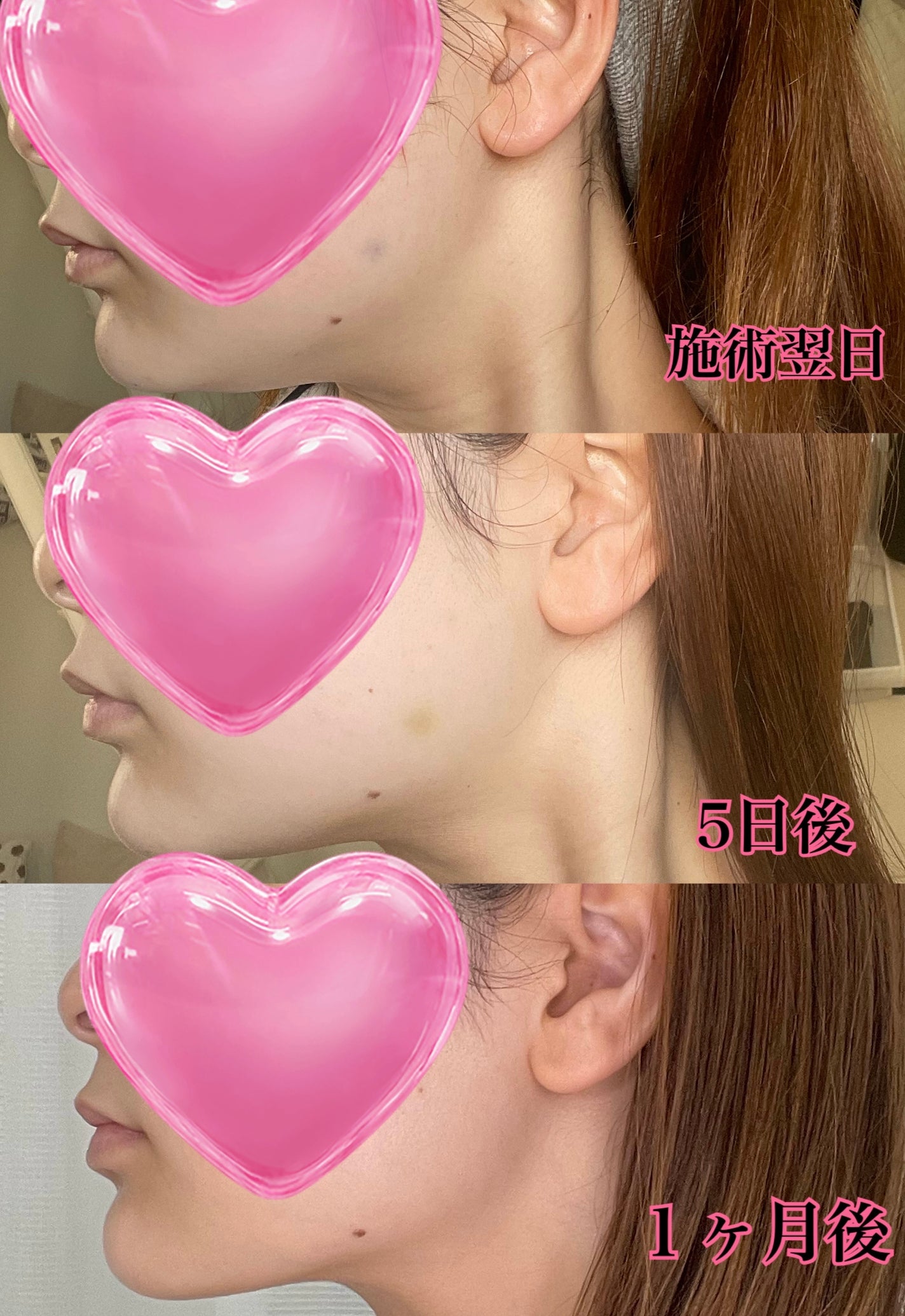 たぬきち(エステティシャン店長) on LIPS 「────────────やってよかった美容施術⚠️最後にビフォ..」(7枚目)