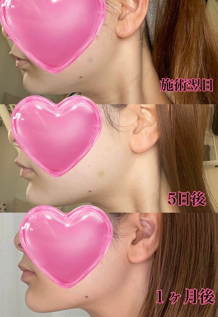 たぬきち(エステティシャン店長) on LIPS 「────────────やってよかった美容施術⚠️最後にビフォ..」(7枚目)