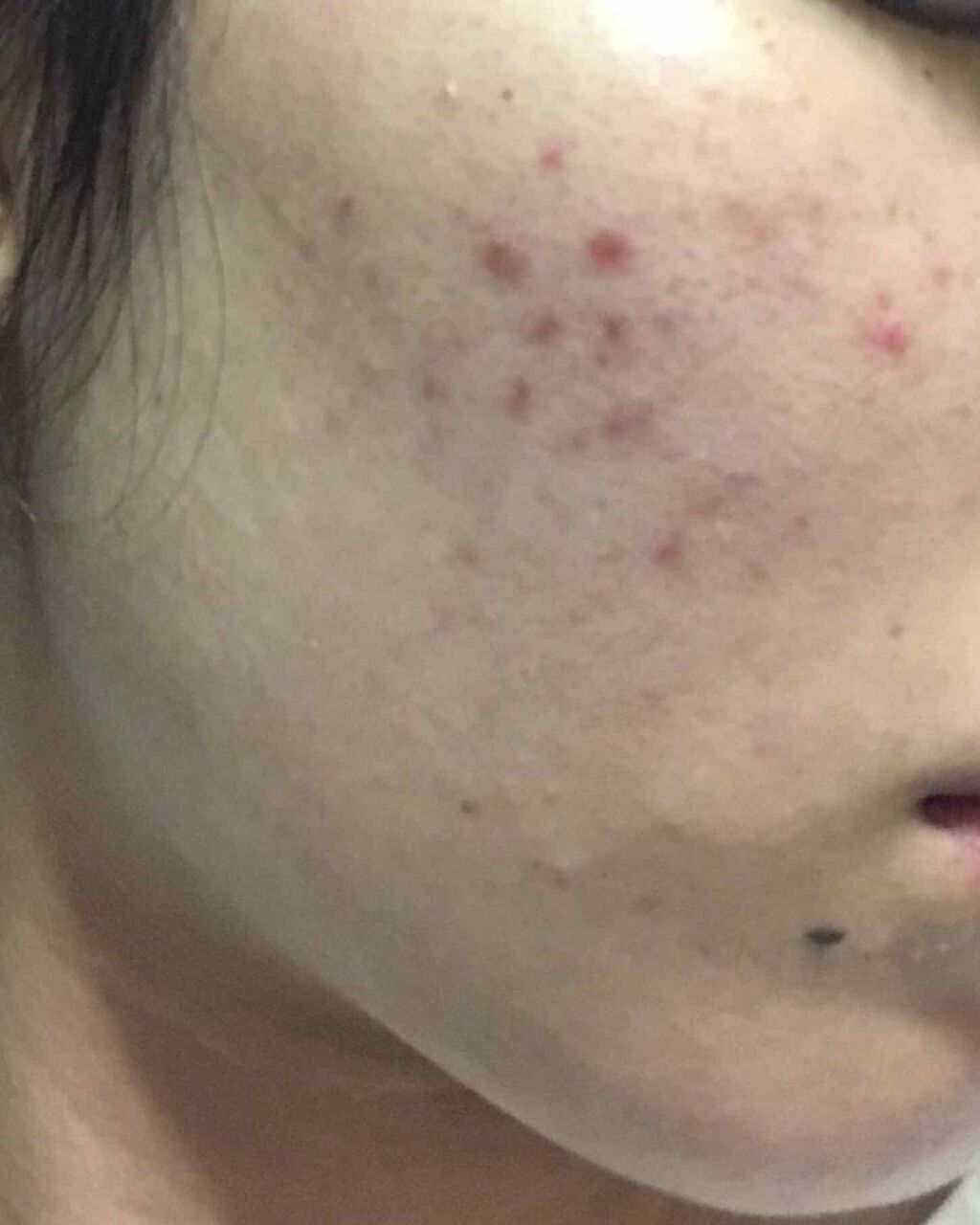 き on LIPS 「ニキビめも..」(2枚目)