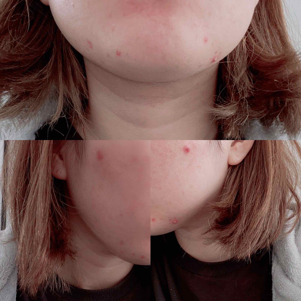 LA10+HAフェイスセラム/The Ordinary/ピーリングを使ったクチコミ（2枚目）